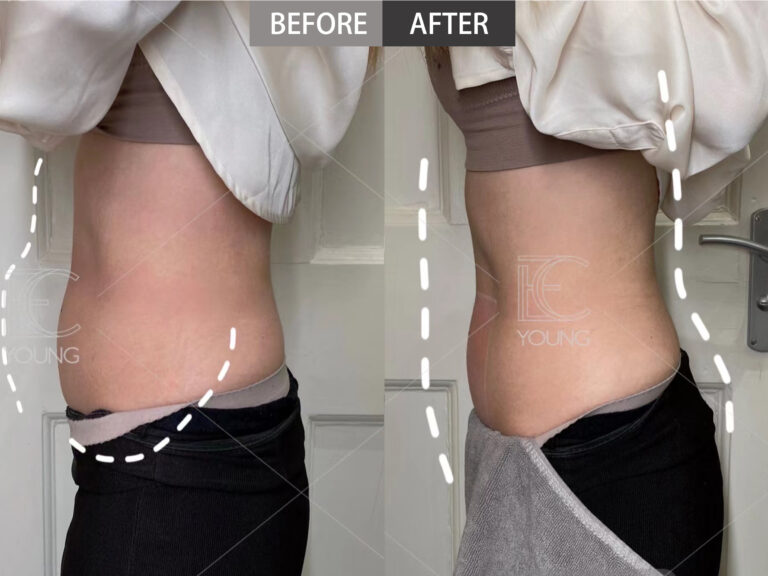 a side portrait of a woman show the difference of abdomen after inmode treatment