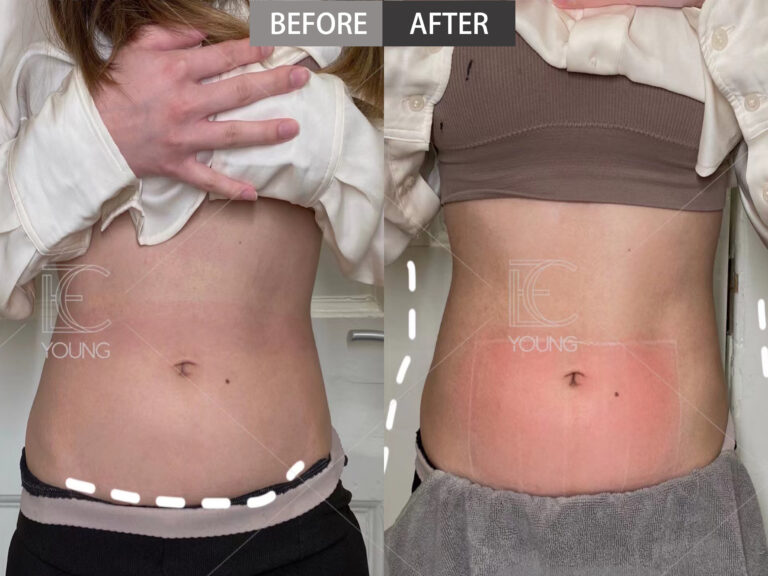 a side portrait of a woman show the difference of abdomen and waist after inmode treatment