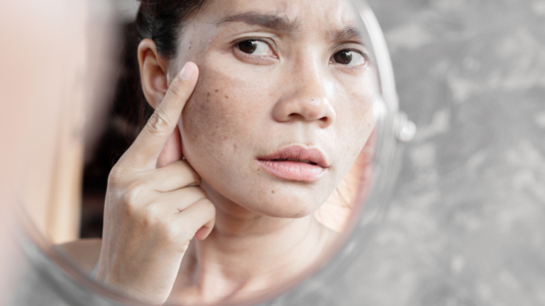 melasma treatment