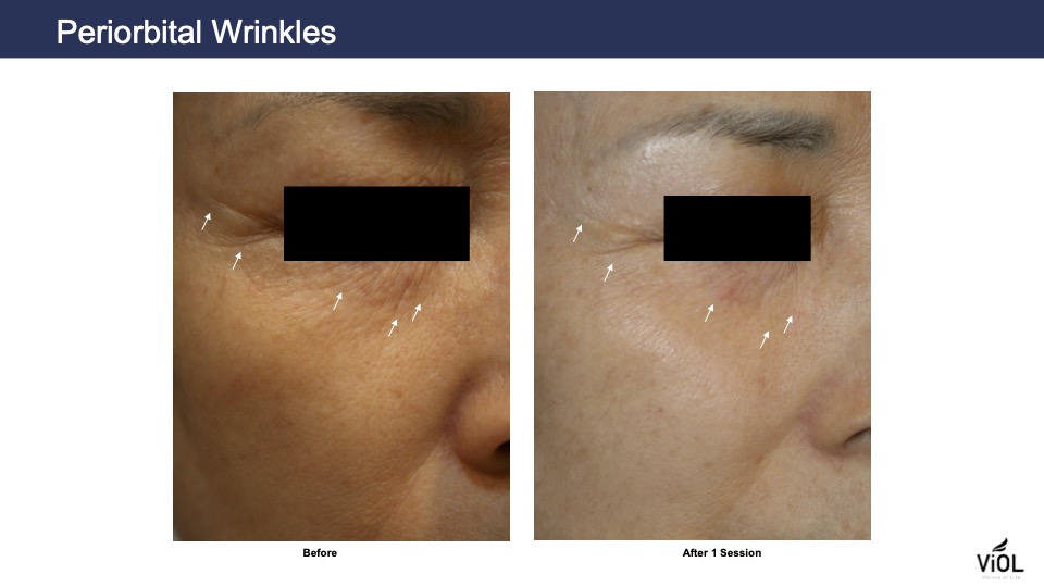 Wrinkles-2.jpg