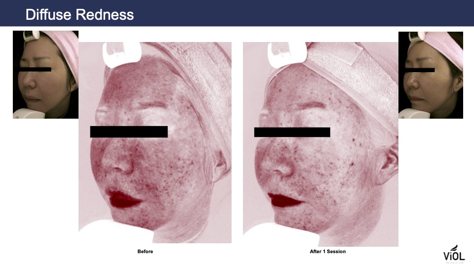 diffuse-redness-1.jpg