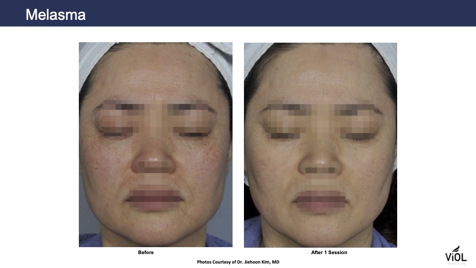 melasma-2.jpg