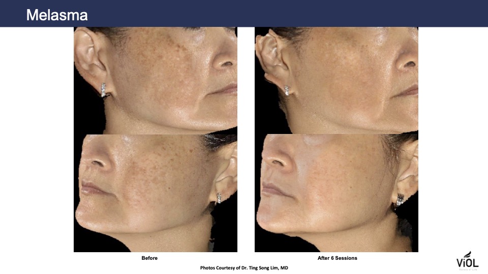 melasma-3.jpg