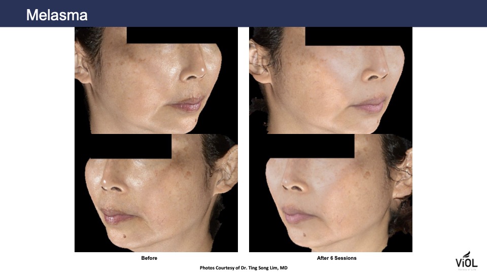 melasma-4.jpg