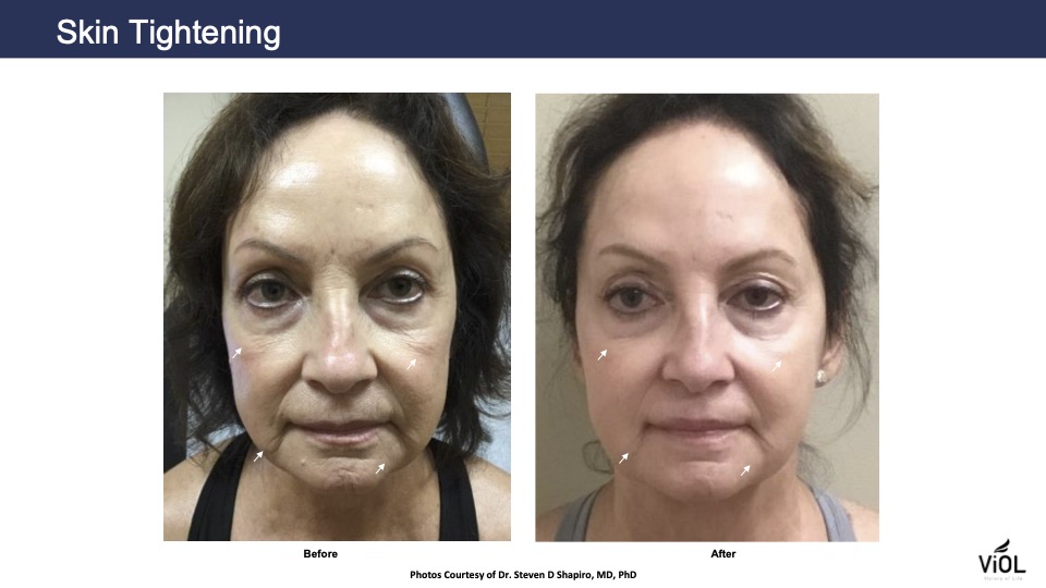 skin-tightening-1.jpg