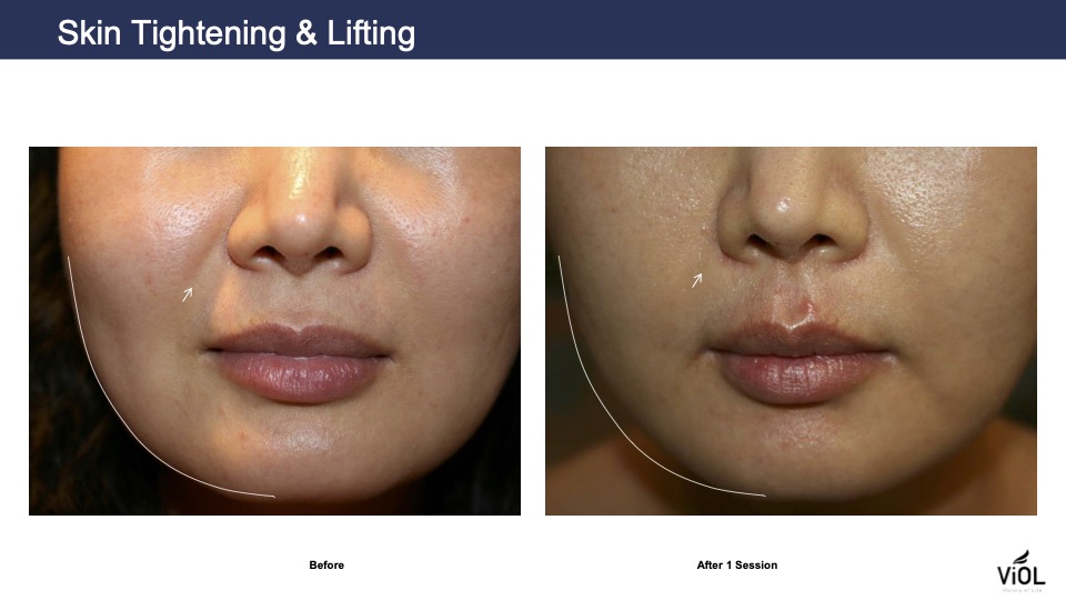 skin-tightening-2.jpg