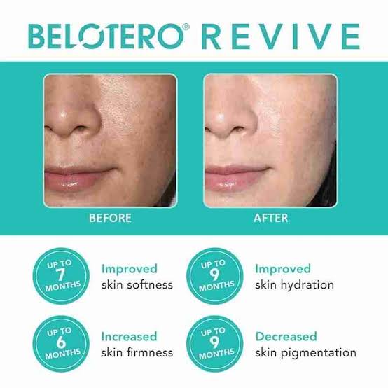 Belotero Revive Before and after