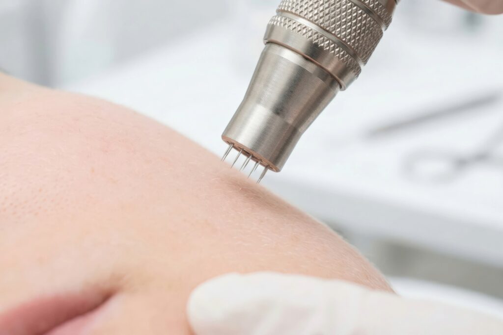 INTRAcel RF Microneedling