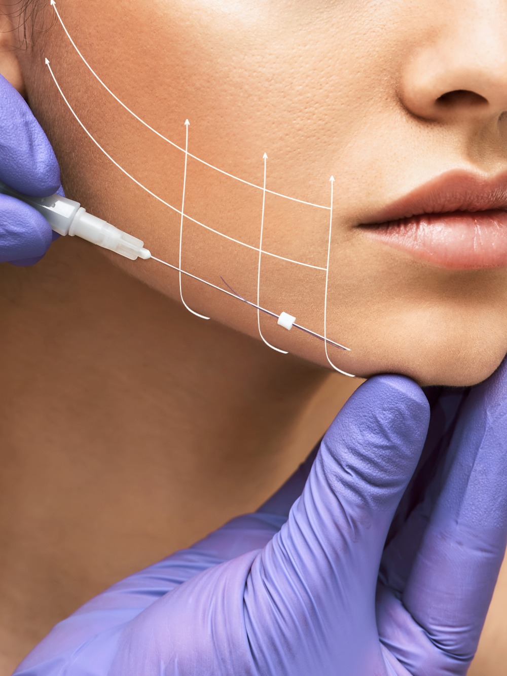 Thread Lift procedure