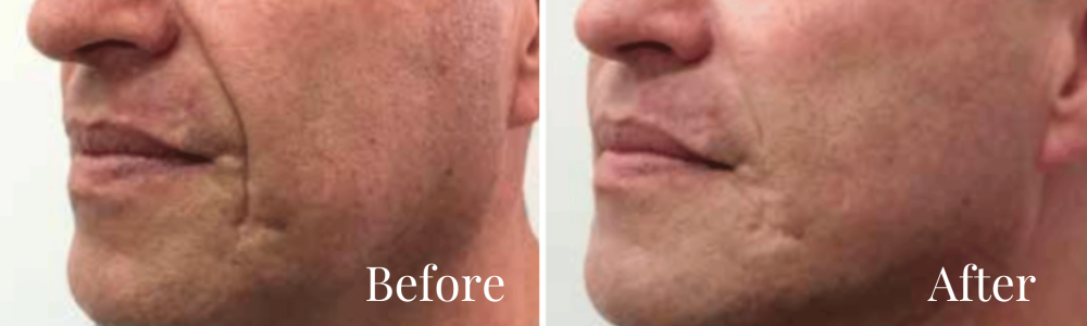 Beforeandafter
