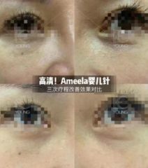 ameela-1